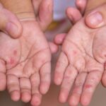 İngiltere’de kızamık vakaları: 2 çocuk hayatını kaybetti
