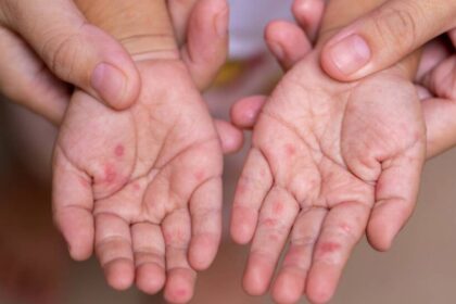 İngiltere’de kızamık vakaları: 2 çocuk hayatını kaybetti