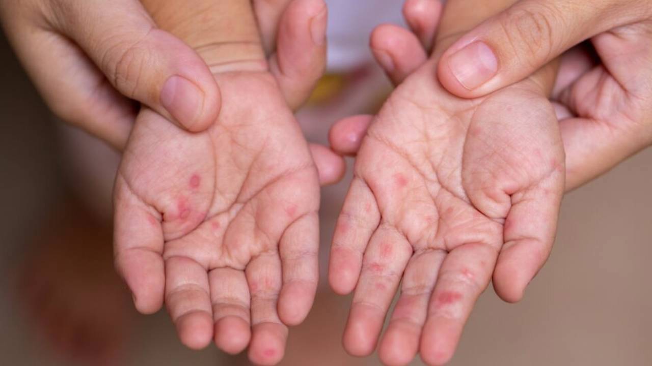 İngiltere’de kızamık vakaları: 2 çocuk hayatını kaybetti